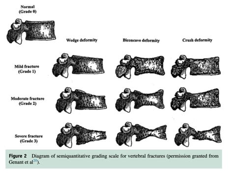 grades of compression fracture